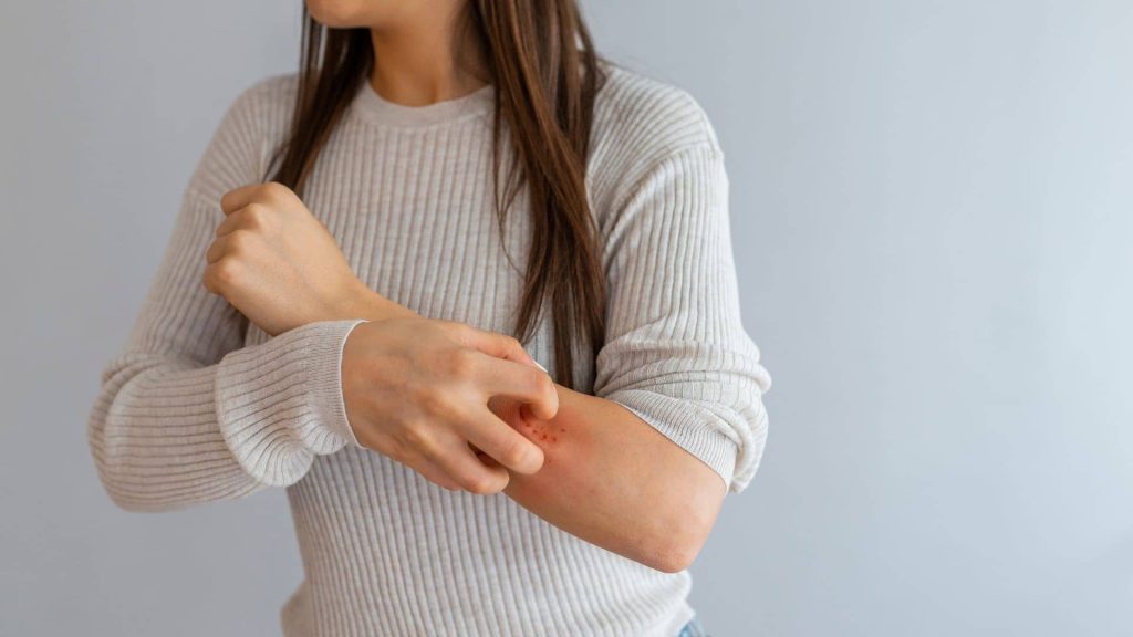 itchiness or hives